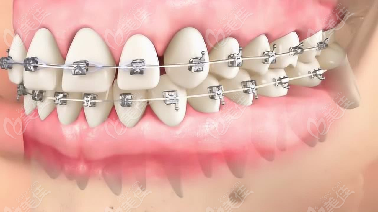判断自己是否适用韩国牙科保险要关注哪些方面? 1 图片