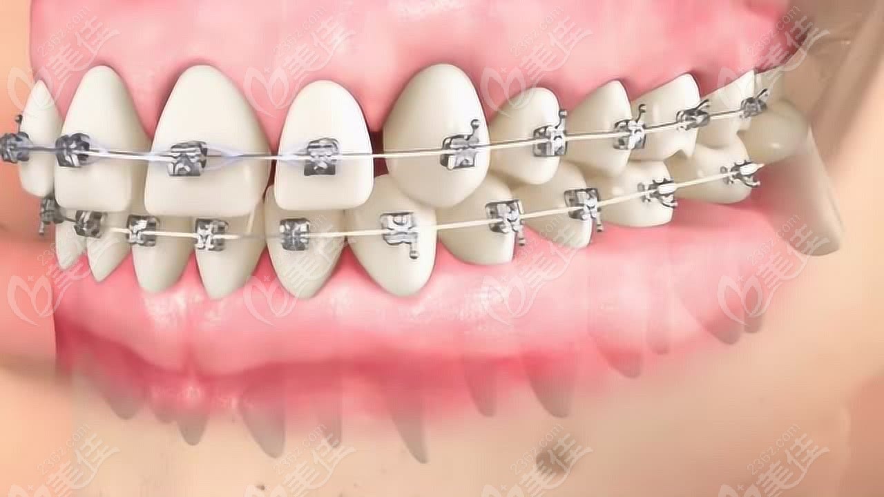 牙科一天能解决:牙痛、补牙、洗牙、拔智齿,你的问题在其中吗? 1 图片