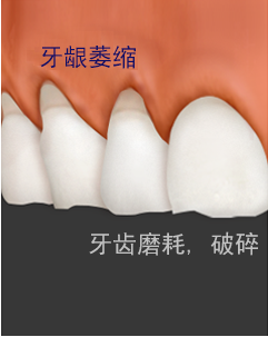 MINISH牙科|MINISH种植牙|MINISH种植牙价格|MINISH全瓷牙修复|MINISH牙科医院|MINISH牙齿贴面|韩国牙科医院|韩国牙齿整形医院|韩国牙齿美容医院|韩国牙科整形价格 이갈이가 심한 치아