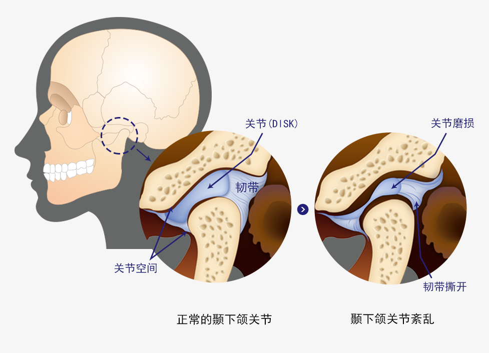 턱관절장애로인한증상