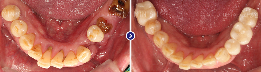 구강사진 5