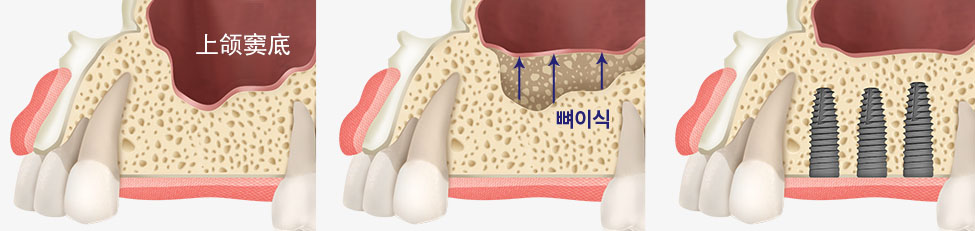 상악동 거상술