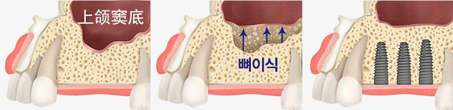 상악동 거상술