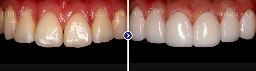 교정 후 뻐드러진 치아