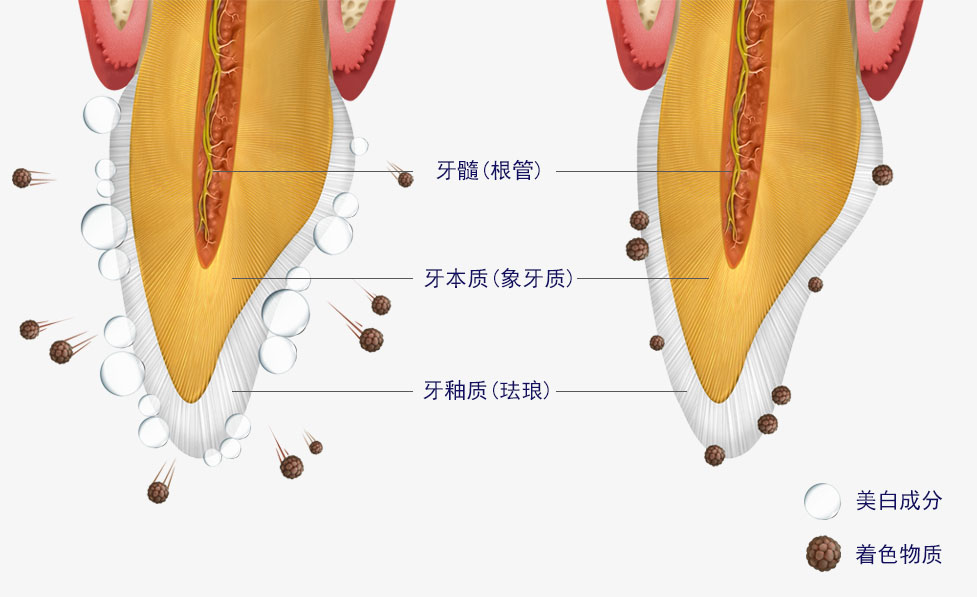 MINISH牙科|MINISH种植牙|MINISH种植牙价格|MINISH全瓷牙修复|MINISH牙科医院|MINISH牙齿贴面|韩国牙科医院|韩国牙齿整形医院|韩国牙齿美容医院|韩国牙科整形价格 생활치 미백 원리