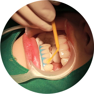 잇몸 보호제, 치아미백제 도포