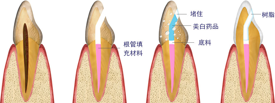 MINISH牙科|MINISH种植牙|MINISH种植牙价格|MINISH全瓷牙修复|MINISH牙科医院|MINISH牙齿贴面|韩国牙科医院|韩国牙齿整形医院|韩国牙齿美容医院|韩国牙科整形价格 실활치 미백 단계