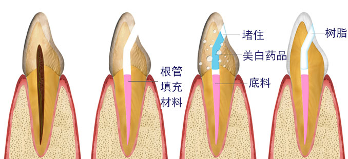 실활치 미백 단계